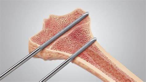 Medical screws processed by turning method