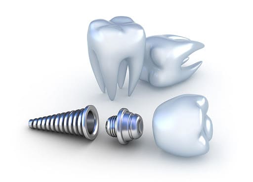 Titanium alloy dental implants